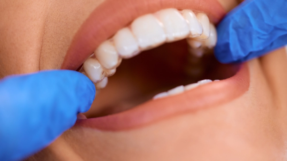Can you go back to normal teeth after composite bonding?
