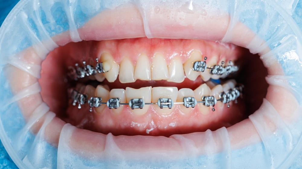 Fixed Metal Braces vs Fixed Transparent Braces: What’s the Difference